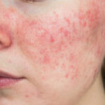 papulopustular rosacea, close-up of the patient's cheek